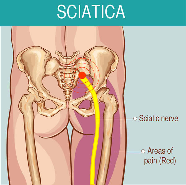 Sciatica